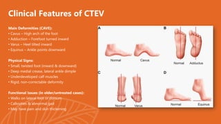 Presentation by Mannat.pdf for CTEV ( club feet) | PDF