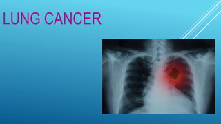 LUNG CANCER
 