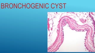 BRONCHOGENIC CYST
 