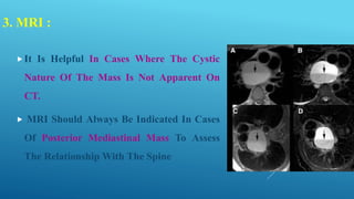 3. MRI :
It Is Helpful In Cases Where The Cystic
Nature Of The Mass Is Not Apparent On
CT.
 MRI Should Always Be Indicated In Cases
Of Posterior Mediastinal Mass To Assess
The Relationship With The Spine
 