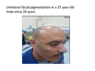 Unilateral facial pigmentation in a 37 year old
male since 20 years
 