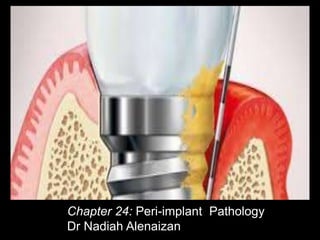 Chapter 24: Peri-implant Pathology
Dr Nadiah Alenaizan
 