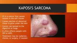 KAPOSI'S SARCOMA
• KS is a cancer that causes
lesions in the soft tissues
• Causes patches of abnormal
tissue to grow under the skin
• Cancer can spread to the
digestive or lungs.
• It often affects people with
HIV or AIDS.
• Treatment may be radiation,
chemo, or surgery, if needed.