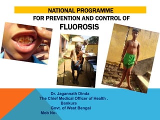 NATIONAL PROGRAMME
FOR PREVENTION AND CONTROL OF
           FLUOROSIS




      Dr. Jagannath Dinda
 The Chief Medical Officer of Health .
            Bankura
      Govt. of West Bengal
 Mob No-
 