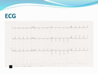 ECG
 