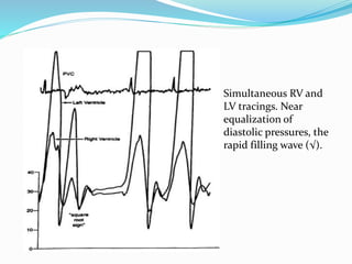 Simultaneous RV and
LV tracings. Near
equalization of
diastolic pressures, the
rapid filling wave (√).
 