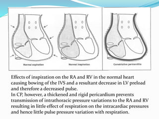 Effects of inspiration on the RA and RV in the normal heart
causing bowing of the IVS and a resultant decrease in LV preload
and therefore a decreased pulse.
In CP, however, a thickened and rigid pericardium prevents
transmission of intrathoracic pressure variations to the RA and RV
resulting in little effect of respiration on the intracardiac pressures
and hence little pulse pressure variation with respiration.
 