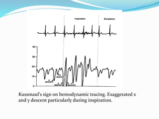 Kussmaul's sign on hemodynamic tracing. Exaggerated x
and y descent particularly during inspiration.
 