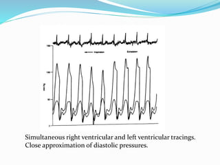 Simultaneous right ventricular and left ventricular tracings.
Close approximation of diastolic pressures.
 