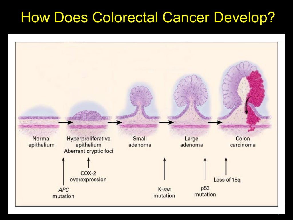 Knowing Cancer of Colon