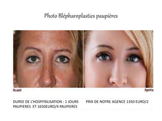 Photo Blépharoplasties paupières
DUREE DE L’HOSPITALISATION : 1 JOURS PRIX DE NOTRE AGENCE 1350 EURO/2
PAUPIERES ET 1650EURO/4 PAUPIERES
 