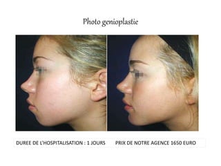 Photo genioplastie
DUREE DE L’HOSPITALISATION : 1 JOURS PRIX DE NOTRE AGENCE 1650 EURO
 
