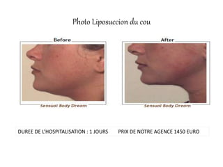 Photo Liposuccion du cou
DUREE DE L’HOSPITALISATION : 1 JOURS PRIX DE NOTRE AGENCE 1450 EURO
 