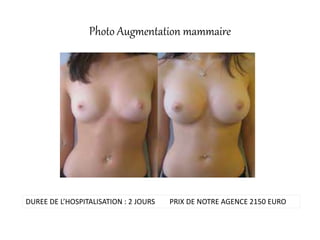 Photo Augmentation mammaire
DUREE DE L’HOSPITALISATION : 2 JOURS PRIX DE NOTRE AGENCE 2150 EURO
 