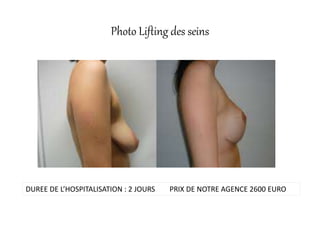 Photo Lifting des seins
DUREE DE L’HOSPITALISATION : 2 JOURS PRIX DE NOTRE AGENCE 2600 EURO
 