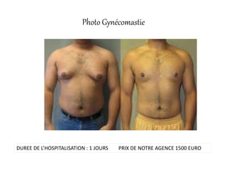 Photo Gynécomastie
DUREE DE L’HOSPITALISATION : 1 JOURS PRIX DE NOTRE AGENCE 1500 EURO
 