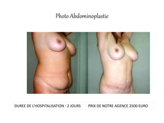 Photo Abdominoplastie
DUREE DE L’HOSPITALISATION : 2 JOURS PRIX DE NOTRE AGENCE 2500 EURO
 