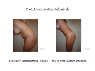 Photo Lipoaspiration abdominale
DUREE DE L’HOSPITALISATION : 2 JOURS PRIX DE NOTRE AGENCE 1850 EURO
 