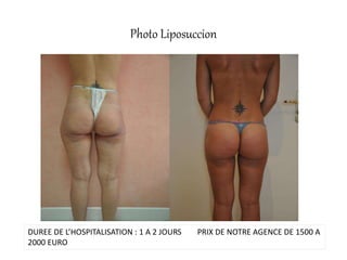 Photo Liposuccion
DUREE DE L’HOSPITALISATION : 1 A 2 JOURS PRIX DE NOTRE AGENCE DE 1500 A
2000 EURO
 
