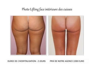 Photo Lifting face intérieure des cuisses
DUREE DE L’HOSPITALISATION : 2 JOURS PRIX DE NOTRE AGENCE 2200 EURO
 