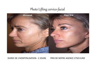 Photo Lifting cervico-facial
DUREE DE L’HOSPITALISATION : 2 JOURS PRIX DE NOTRE AGENCE 2750 EURO
 