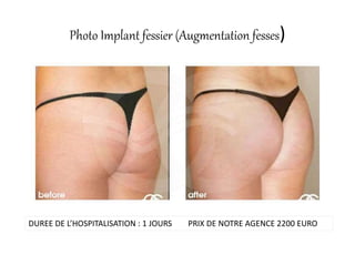 Photo Implant fessier (Augmentation fesses)
DUREE DE L’HOSPITALISATION : 1 JOURS PRIX DE NOTRE AGENCE 2200 EURO
 