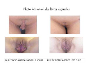 Photo Réduction des lèvres vaginales
DUREE DE L’HOSPITALISATION : 0 JOURS PRIX DE NOTRE AGENCE 1250 EURO
 