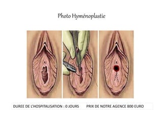 Photo Hyménoplastie
DUREE DE L’HOSPITALISATION : 0 JOURS PRIX DE NOTRE AGENCE 800 EURO
 