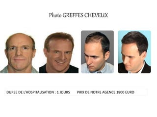 Photo GREFFES CHEVEUX
DUREE DE L’HOSPITALISATION : 1 JOURS PRIX DE NOTRE AGENCE 1800 EURO
 