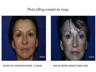 Photo Lifting complet du visage
DUREE DE L’HOSPITALISATION : 2 JOURS PRIX DE NOTRE AGENCE 3050 EURO
 