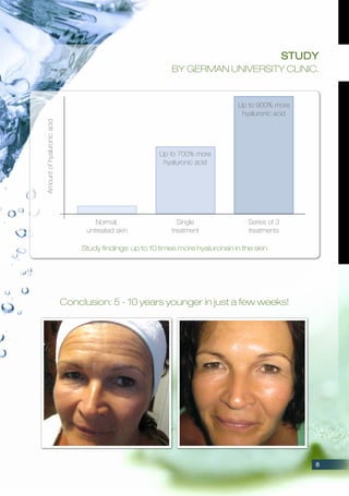 Conclusion: 5 - 10 years younger in just a few weeks!
Amountofhyaluronicacid
Normal,
untreated skin
Up to 700% more
hyaluronic acid
Single
treatment
Up to 900% more
hyaluronic acid
Series of 3
treatments
Study findings: up to 10 times more hyaluronan in the skin
Study
by German university clinic.
8
 