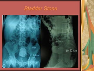 Endourology.ppt