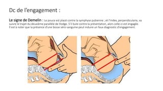 Dc de l’engagement :
Le signe de Demelin : Le pouce est placé contre la symphyse pubienne ; et l’index, perpendiculaire, va
suivre le trajet du deuxième parallèle de Hodge. S’il bute contre la présentation, alors celle-ci est engagée.
ll est à noter que la présence d'une bosse séro-sanguine peut induire un faux diagnostic d'engagement.
 