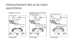 Chevauchement des os du crane
asynclitisme
 
