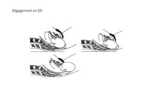 Dégagement en OS
 
