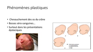 Phénomènes plastiques
• Chevauchement des os du crâne
• Bosses séro-sanguines…
• Surtout dans les présentations
dystociques
 