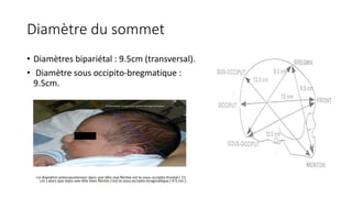 Diamètre du sommet
• Diamètres bipariétal : 9.5cm (transversal).
• Diamètre sous occipito-bregmatique :
9.5cm.
 