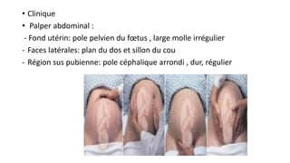 • Clinique
• Palper abdominal :
- Fond utérin: pole pelvien du fœtus , large molle irrégulier
- Faces latérales: plan du dos et sillon du cou
- Région sus pubienne: pole céphalique arrondi , dur, régulier
 