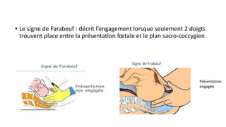 • Le signe de Farabeuf : décrit l’engagement lorsque seulement 2 doigts
trouvent place entre la présentation fœtale et le plan sacro-coccygien.
Présentation
engagée
Signe de Frabeuf
 
