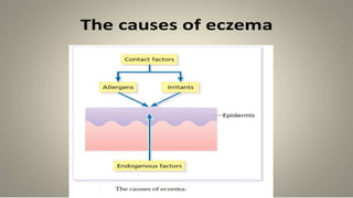 The causes of eczema
 