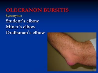 OLECRANON BURSITIS
Synonyms:
Student’s elbow
Miner’s elbow
Draftsman’s elbow
 