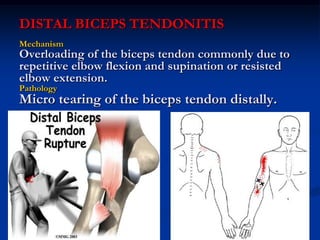DISTAL BICEPS TENDONITIS
Mechanism
Overloading of the biceps tendon commonly due to
repetitive elbow flexion and supination or resisted
elbow extension.
Pathology
Micro tearing of the biceps tendon distally.
 