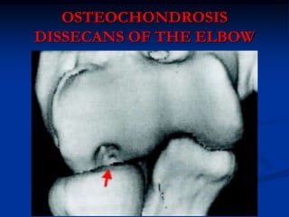 OSTEOCHONDROSIS
DISSECANS OF THE ELBOW
 