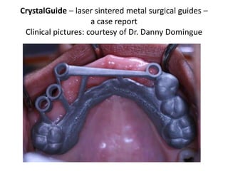 CrystalGuide – laser sintered metal surgical guides –
                     a case report
 Clinical pictures: courtesy of Dr. Danny Domingue
 