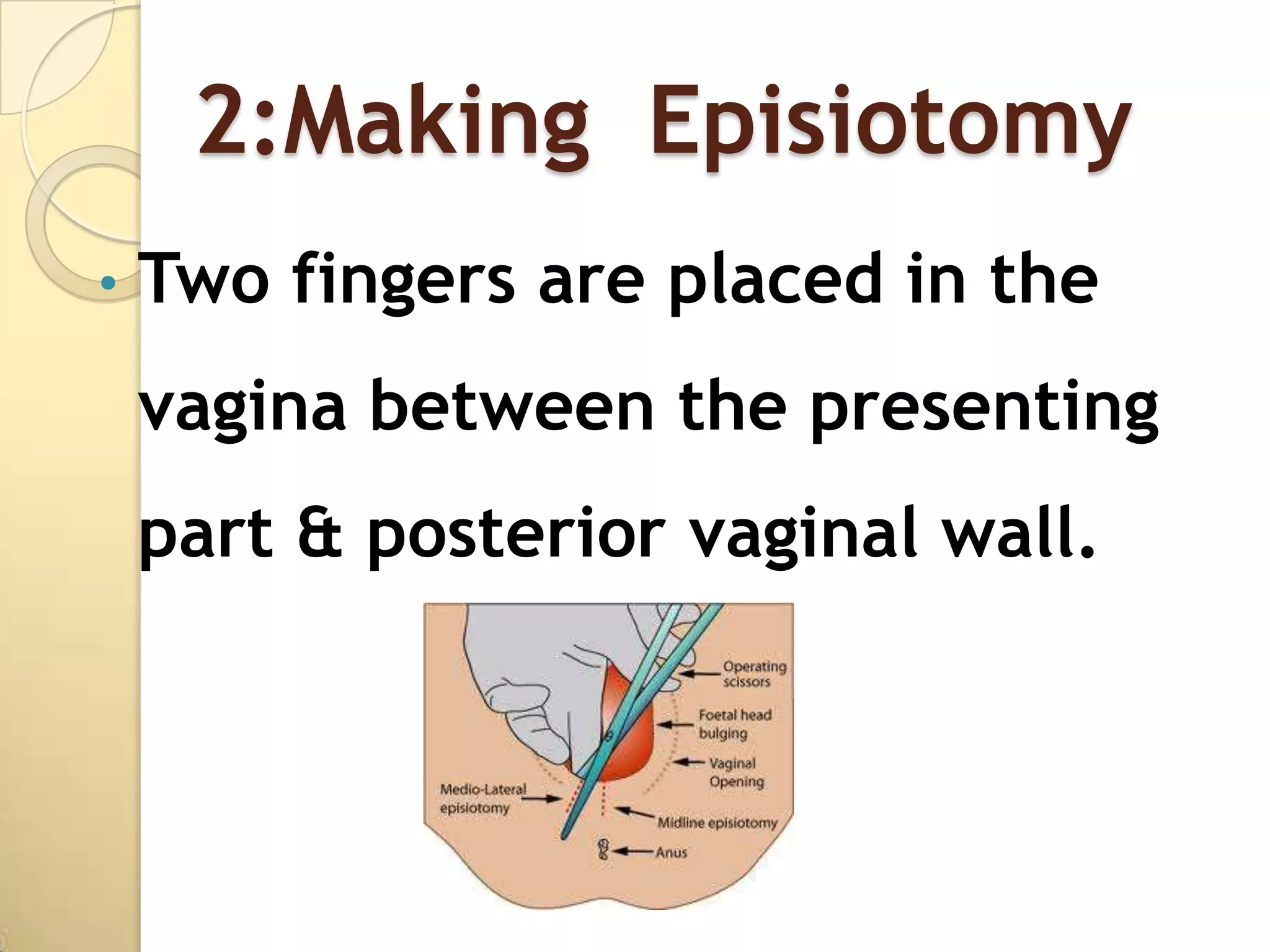 2:Making Episiotomy
•   Two fingers are placed in the
    vagina between the presenting
    part & posterior vaginal wall.
 