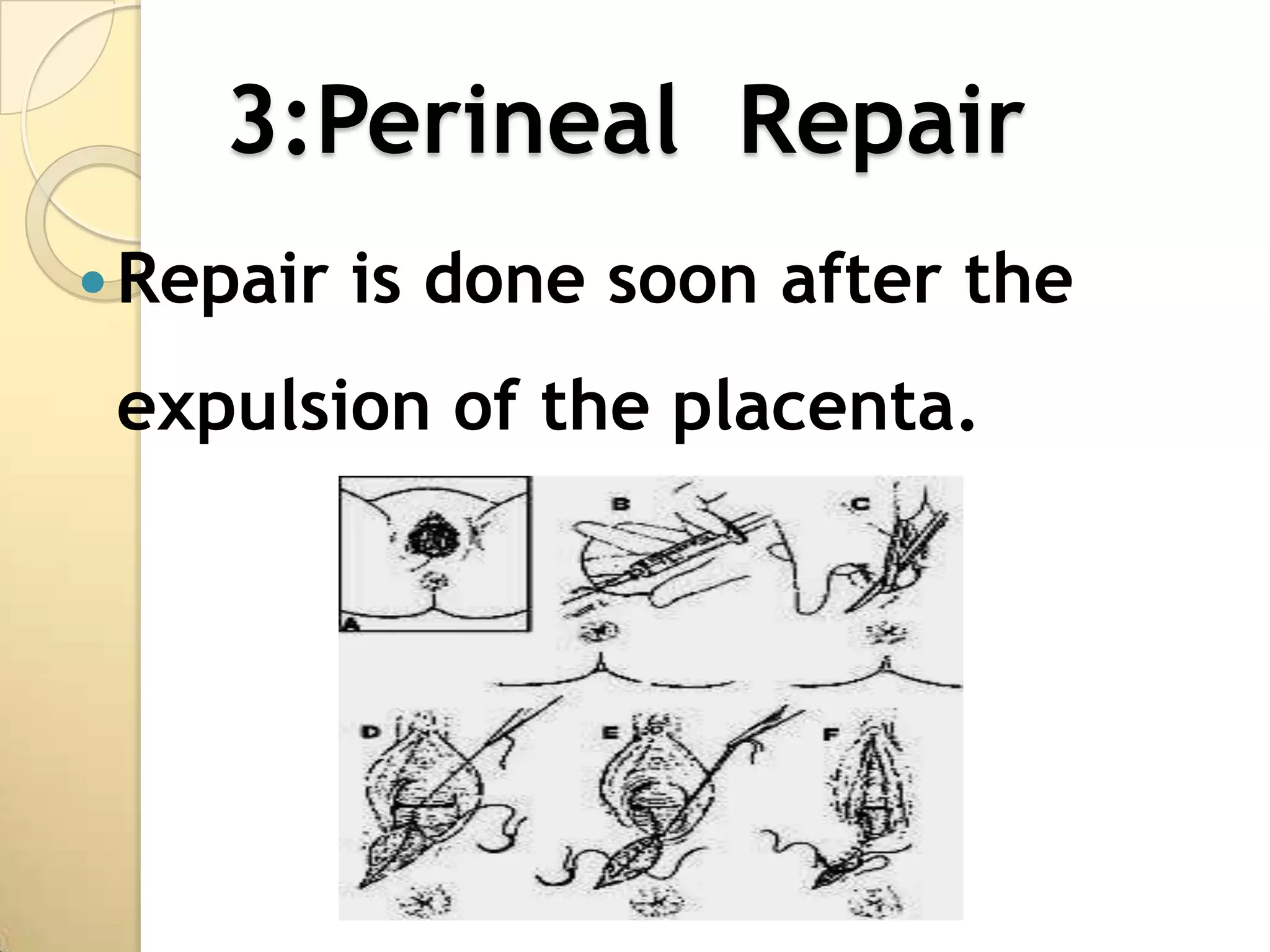 3:Perineal Repair
 Repair   is done soon after the
 expulsion of the placenta.
 