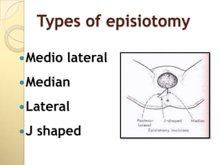 Types of episiotomy

 Medio   lateral
 Median

 Lateral

J   shaped
 