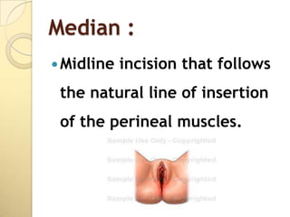 Median :
 Midline   incision that follows
 the natural line of insertion
 of the perineal muscles.
 
