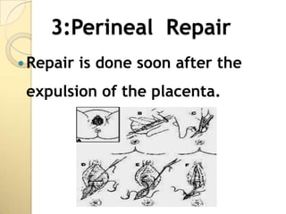 3:Perineal Repair
 Repair   is done soon after the
 expulsion of the placenta.
 