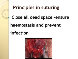 Principles in suturing

   Close all dead space –ensure
    haemostasis and prevent
    infection
 